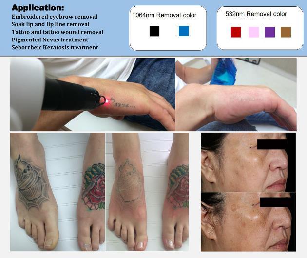 High Power Tattoo Removal Q-Switch ND: YAG Laser