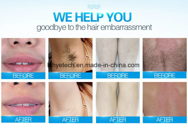 Professional Manufacturer 808nm Diode Laser Hair Removal for Sale