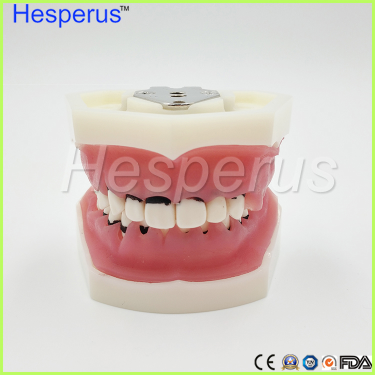 Dental Periodontal Disease Teeth Model / Tooth Medical Model Hesperus