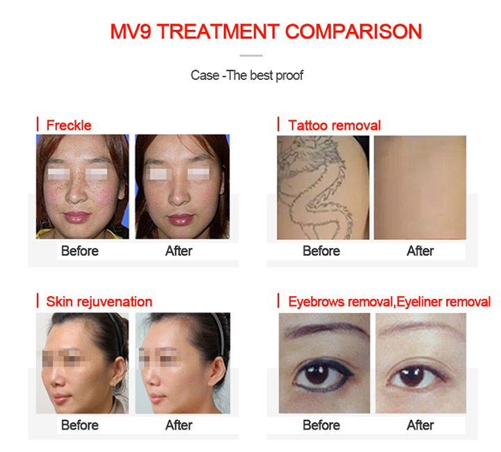 ND YAG Laser Tattoo Removal Machine for Skin Rejuvenation