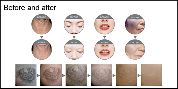 Effective Q Switch ND YAG Laser Tattoo Removal