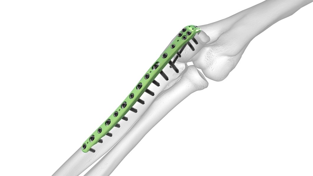 Bone Fracture Healing Implant Proximal Tibia Lateral Locking Plate