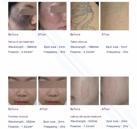 ND YAG Laser Pigmentation Tattoo Removal Skin Mole Removal Machine