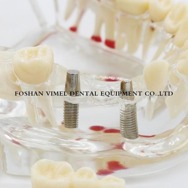 Dental Study Tooth Transparent Pathological Teeth Model for Adult Teaching