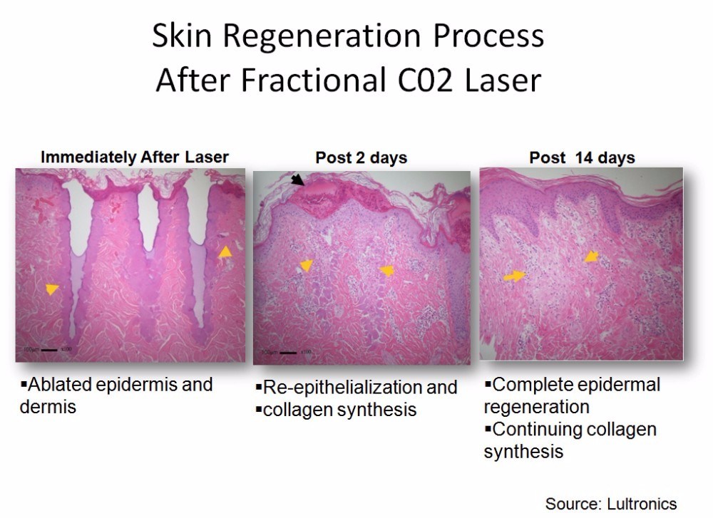 Professional Fractional CO2 Laser for Vaginal Tightening