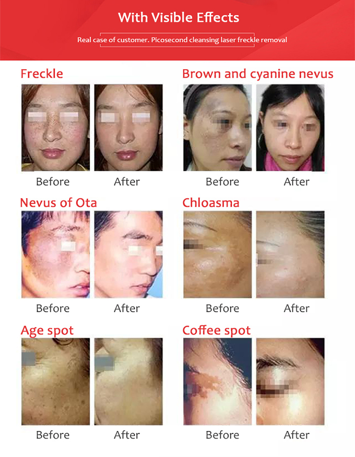 Professional Picosecond 1064nm Laser Melasma Pigmentation Tattoo Removal Beauty Equipment