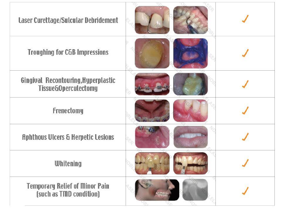 Diode Laser Teeth Whitening Machine