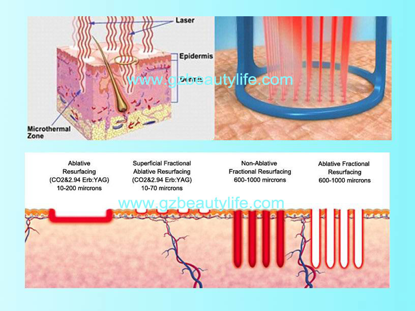 RF Tube Professional Fractional CO2 Laser Machine /Fractional CO2 Amazing Effect