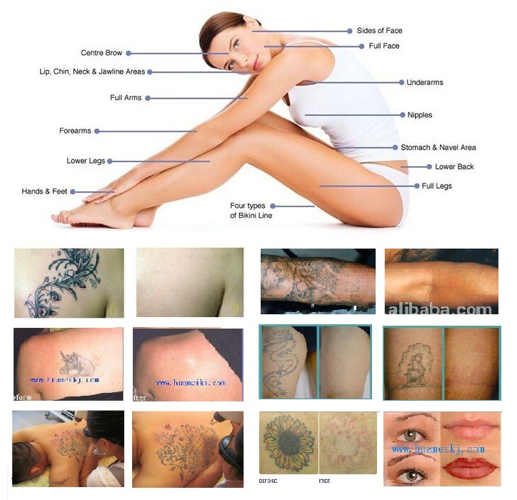 Q-Switch Medical Equipment Q Switched ND\: YAG Laser Tattoo Removal Beauty Machine Price