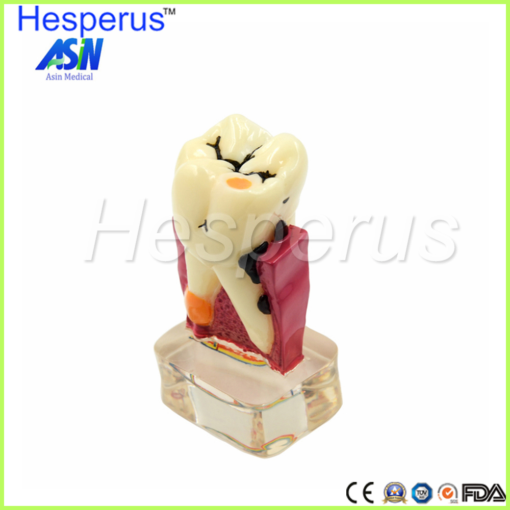 4: 1 Dentist Dental Study Teach Tooth Model Teeth Disease Model