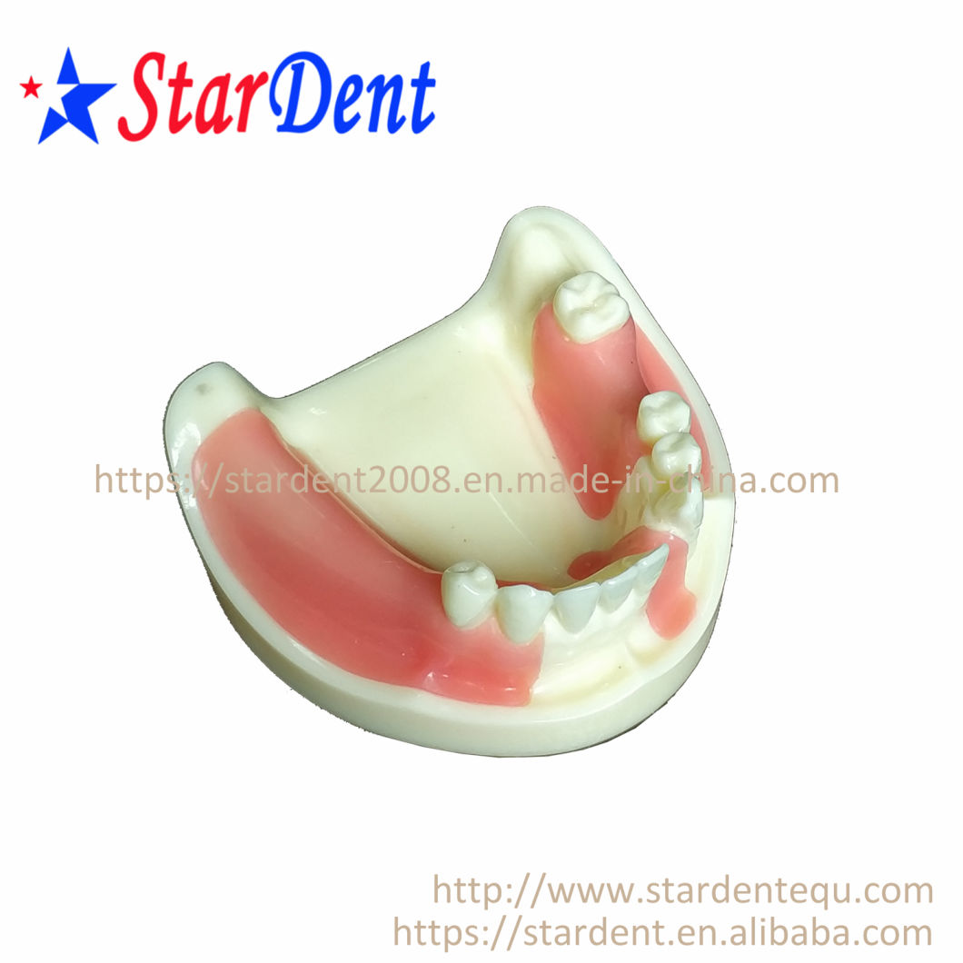 Dental Teeth Implant Practice Model