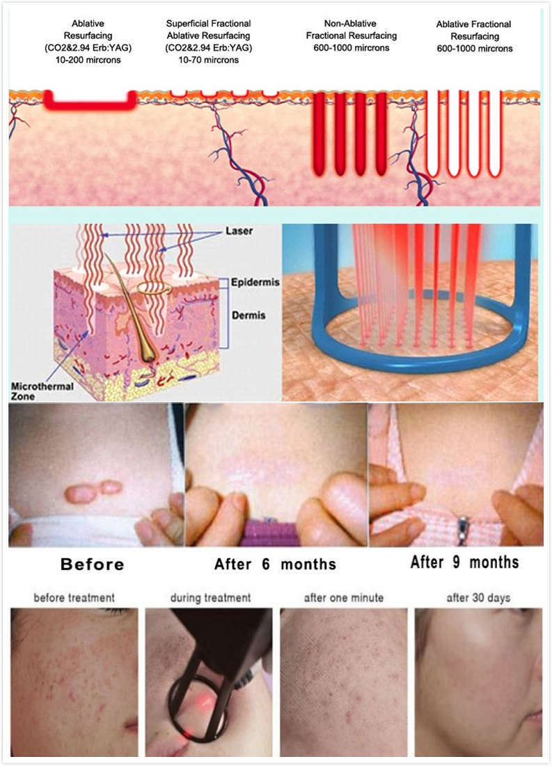 Km Fractional CO2 Laser Scars Removal Machine CO2 Lasers