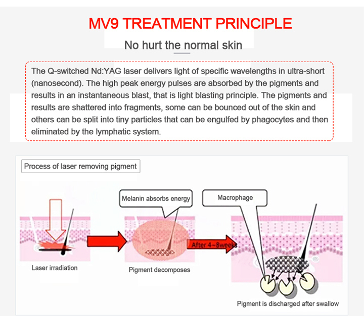 ND YAG Laser Tattoo Removal Machine for Skin Rejuvenation