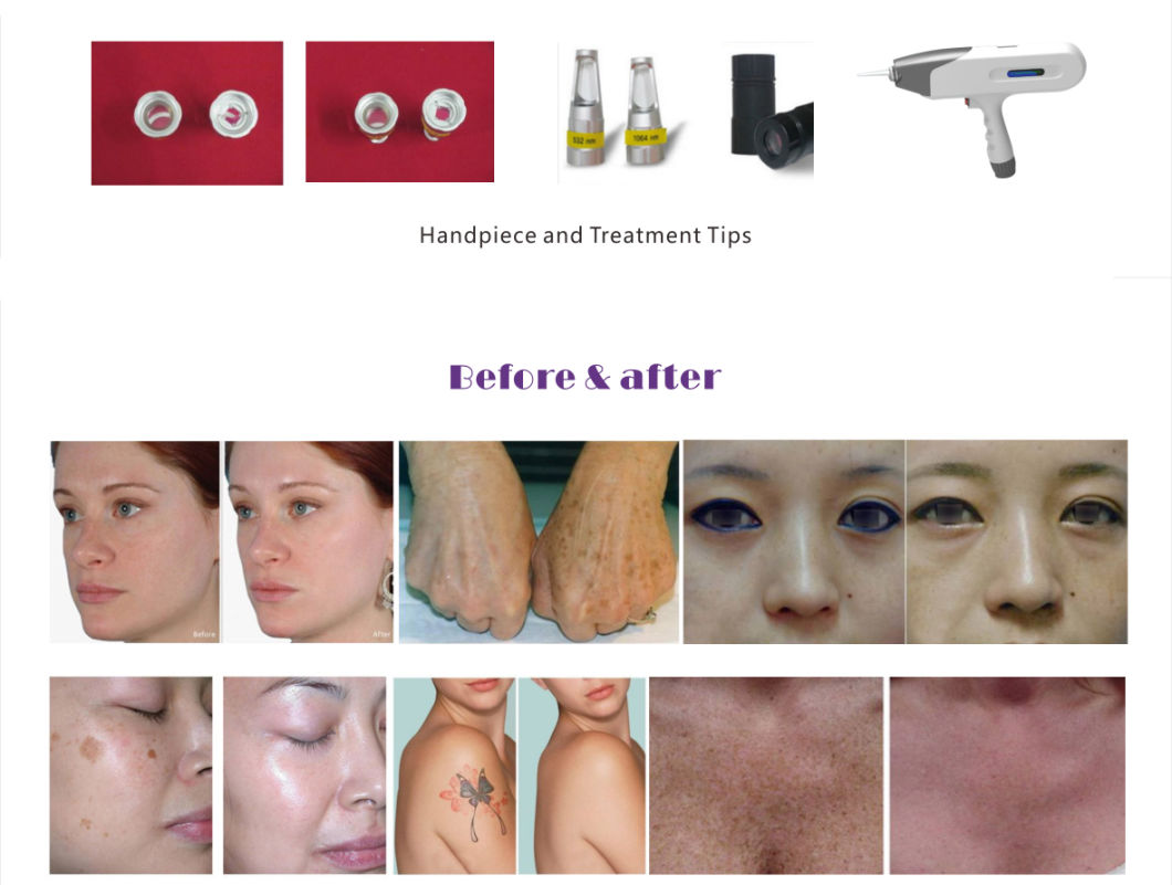 Laser Tattoo Removal Age Spot Removal with Ce Approval Machine