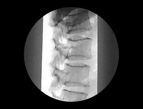 High Frequency Mobile Digital C-Arm X-ray Machine