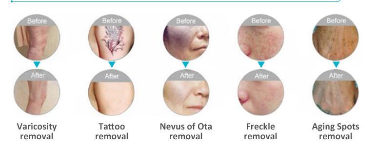 Q Switched ND YAG Laser Tattoo Removal Laser Hair Removal