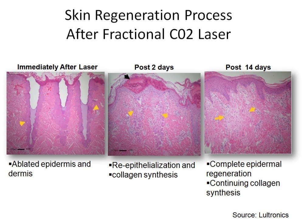 Scar Wrinkle Removal Skin Refresh CO2 Fractional Medical Laser Machine