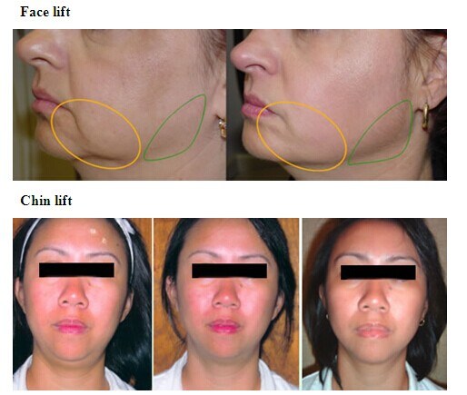 Beauty Machine RF Fractional for Face Lifting Skin Rejuvenation