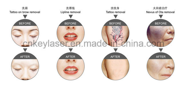 Q-Switch ND YAG Laser Tattoo Remvoal Machine