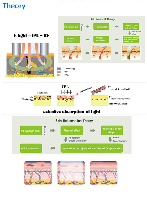 IPL Shr E-Light Opt Skin Rejuvenation Acne Scar Hair Removal Machine