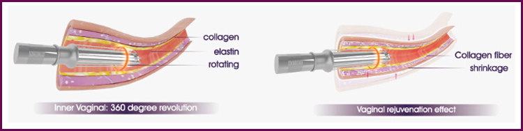 CO2 Fractional Laser Pigment Treatment Beauty Equipment