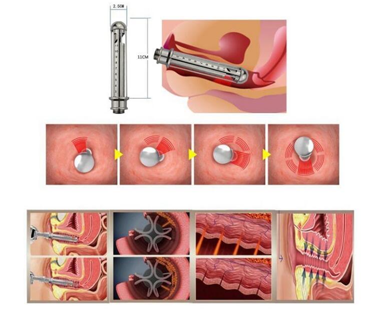 RF CO2 Fractional Laser Physiotherapy Laser Equipment