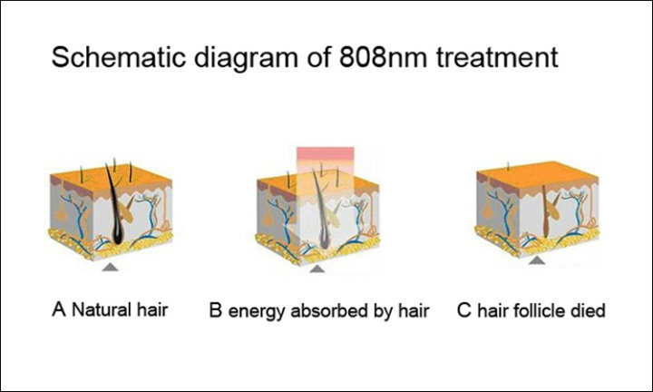 Hair Removal Diode Laser 808nm