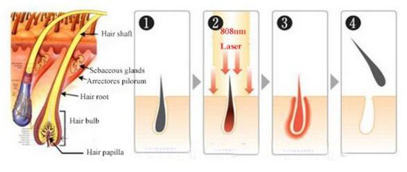 Non Channel 808nm Diode Laser Hair Removal