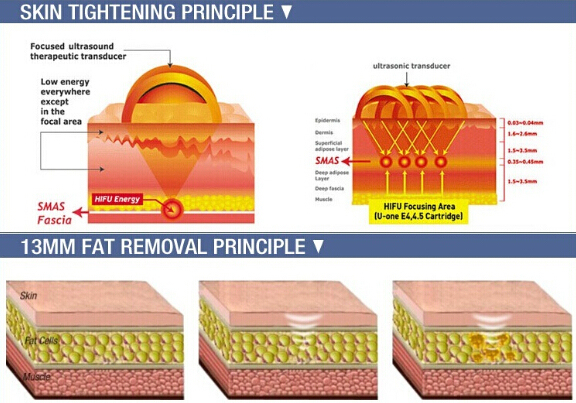 Most Popular Anti Aging Wrinkle Removal Hifu for Skin Tightening