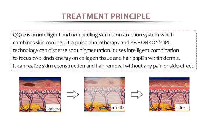 IPL Laser Skin Rejuvenation Acne Removal