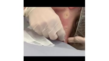 Reborn PLLA dermal filler for neck treatment