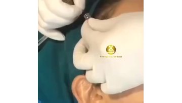 Beautiful molding cog pdo thread lifting hilos tensores lifting cog ojos 30 g 25mm1