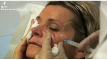 manufacturer supply reborn plla dermal filler for face volumizing