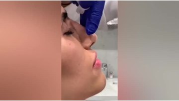 dermal filler