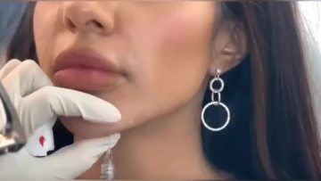 Shangyang PDO Threads Lift Screw For Face/Whole Body Smooth Tighten Lifting1