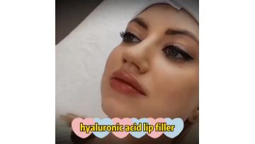 Ha filler  3