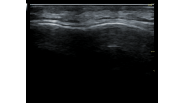 Glabella imaging from 15L high frequency handheld probe