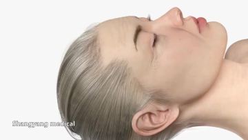 Obvious effective pdo cog 4d thread for lifting face and body no needle thread lift facial thread lift1