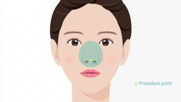Hot sell pdo thread lift/beauty pdo thread lift hilos tensores de fill plla mono face eye threads cog1