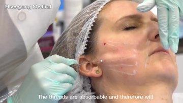 Hot selling pdo thread for nose mesh pdo thread for body lifting face lifting thread pdo1