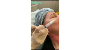 Reborn PLLA Filler for Ear Correction