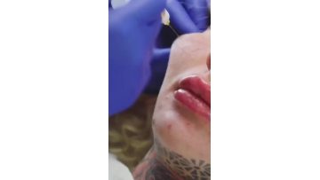 Ha filler  16