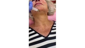neck injection filler
