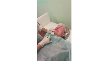 Chin Injection with Reborn PLLA 360mg