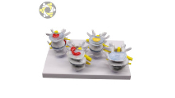 Pathological 4-Stage Human Lumbar Vertebrae Spine Disease Model1