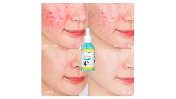 Anti Acne Treatment Serum