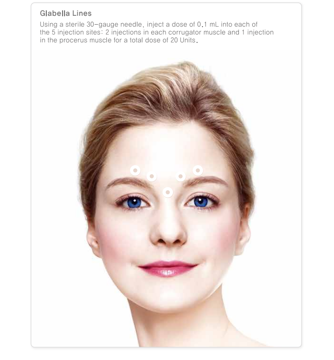 Nabota 100/200 Units Botulintoxin Toxin Injection