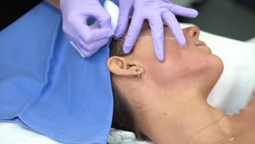 Pdo cog thread lift korea collagen pdo thread face lift pdo thread mono1