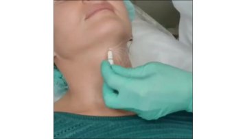 Injectable PLLA Dermal Filler Bebore and After