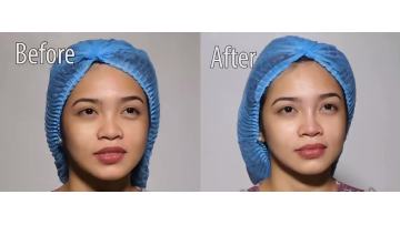 Pdo cog thread for nose silk protein thread lifts tighten collagen pdo thread for nose lift1
